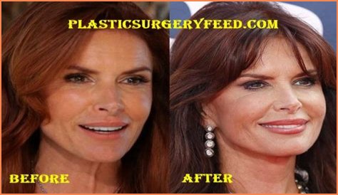 Roma Downey Plastic Surgery Before and After